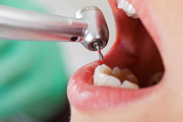 Best Emergency Dentist for Lost Fillings or Crowns in St Joseph, IL